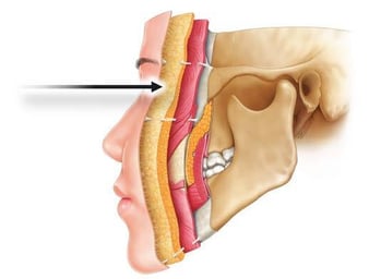 Skeletal illustration of profiled skull with arrow pointing behind eyes